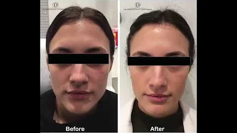 Dr. Arash Akhavan Blood Mask NYC