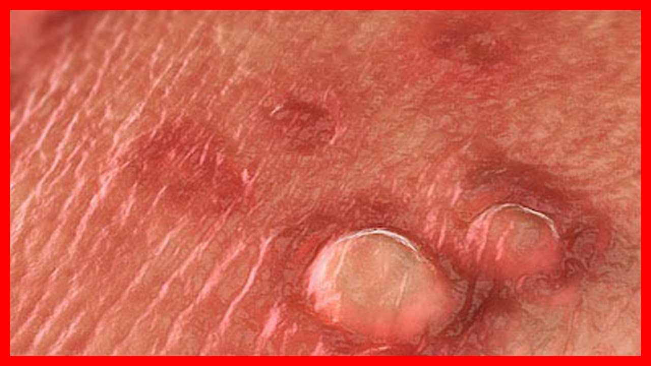 HPV Treatment: Warts, Genital Warts, Cervical Dysplasia HPV Treatment: Warts, Genital Warts, Cervical Dysplasia new pics HPV Treatment: Warts, Genital Warts, Cervical Dysplasia HPV Treatment: Warts, Genital Warts, Cervical Dysplasia new pics