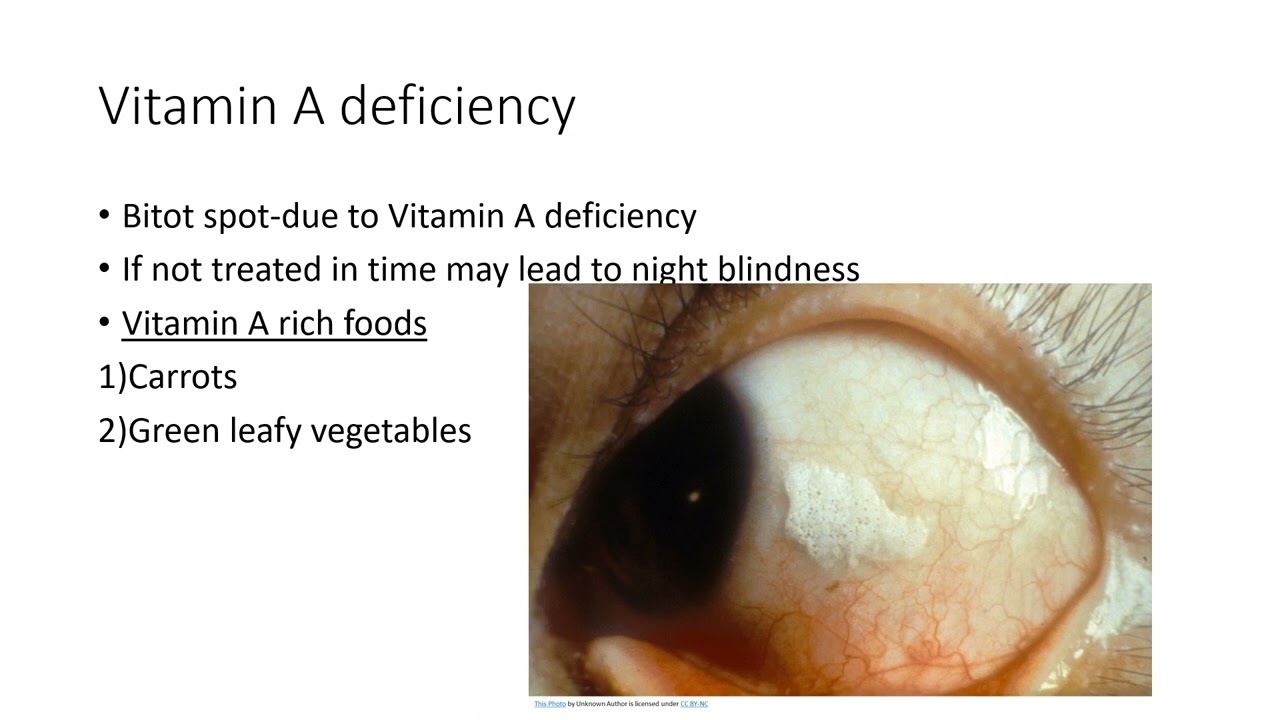 Vitamin A deficiency