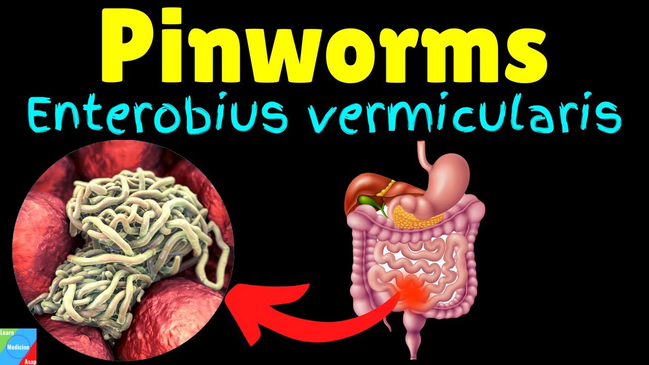 Pinworms (Threadworms): Symptoms, Causes, Treatments, Life Cycle –  Enterobius vermicularis 