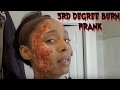 3rd Degree Burned Prank 🔥