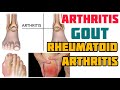 Arthritis, Gout at Rheumatoid Arthritis - Payo ni Doc Gary Sy at Doc Willie Ong #3b