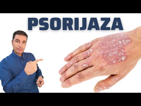 Video: Ima li psorijazu na vlasištu?