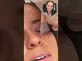 Reinicio de Piel con Neogen Plasma | Rejuvenecimiento No Quirúrgico en Jacksonville