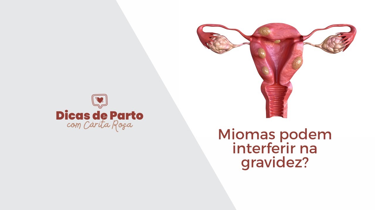 Miomas podem interferir na gravidez?