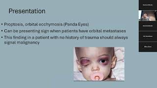 01.03.2025, “Updates in Multidisciplinary Management of Neuroblastoma”