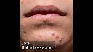 Episodio 150 Del 310124. Finalmente Trovata La Cura Dellacne.