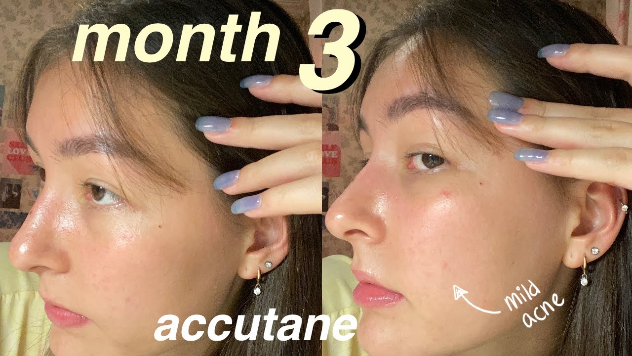 accutane journey malaysia