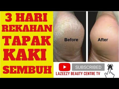 Video: 3 Cara Dapatkan Tumit Lembut