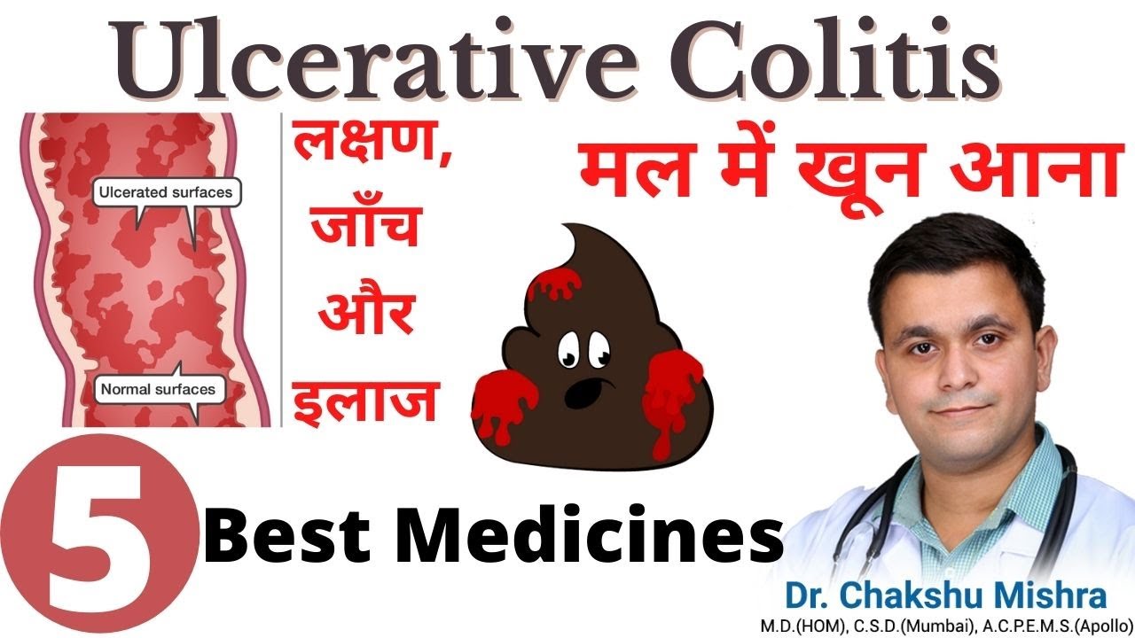 Ulcerative Colitis treatment and symptoms. Best medicine for ulcerative ...