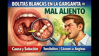 Bolitas blancas en la garganta = MAL ALIENTO | Causa y solución