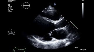 Ischemic Cardiomyopathy 2D Echocardiogram