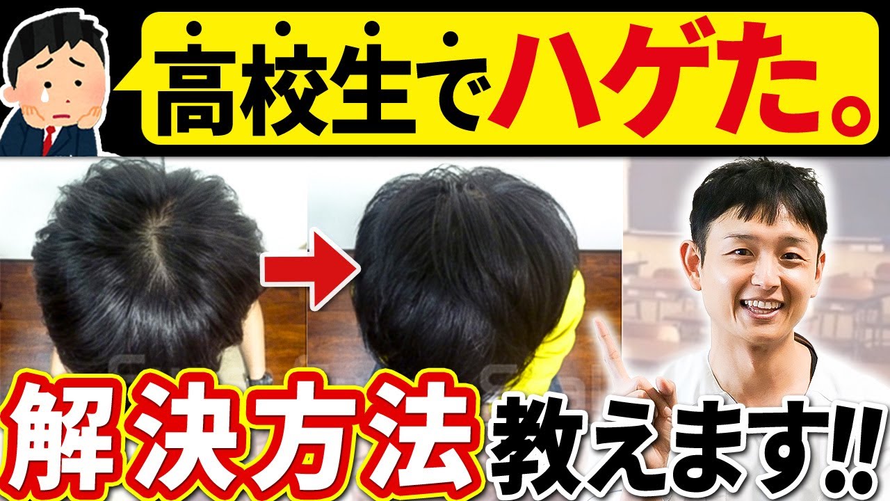 つむじ はげ 高校生