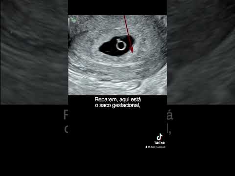 Начальная беременность - АЛМАЗНОЕ КОЛЬЦО #gestante #gravidez #ultrassom #bebe #gestacao