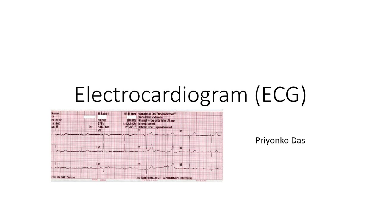 Electrocardiogram (ECG) | Understanding of Electrical Signature of ...