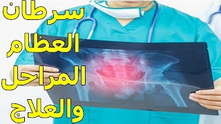 هل سرطان العظام مميت ؟؟ | معلومات هامة على الجميع معرفتها