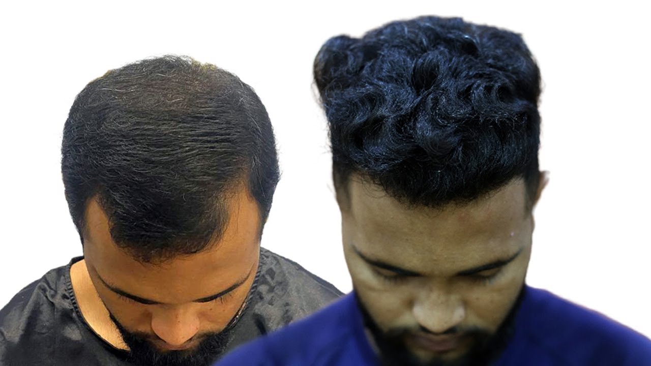 Hairline Hair Transplant In Raipur Monthwise Results YouTube