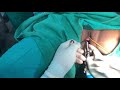 How to install halders uterine manipulator