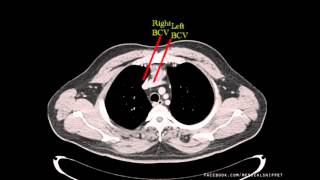 Major Thoracic Vessels | Venous