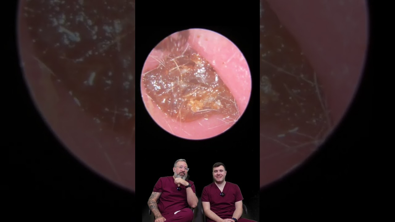 HARD AS A ROCK! Deep Ear Wax Plug Removal 😱👂