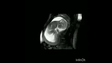 سبحان الله كيف يتحرك الجنين في بطن امه 