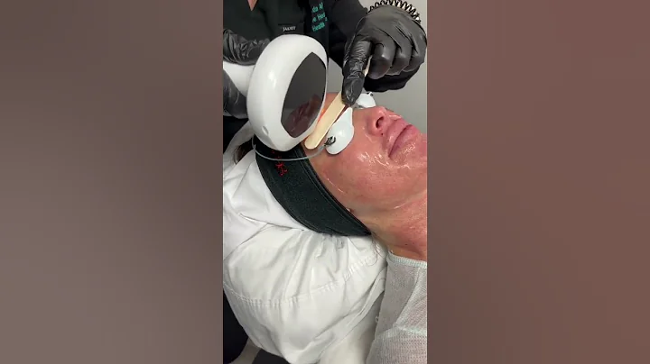 Amazing changes in skin texture after the Lumecca treatment! | #beauty #skincare #shorts