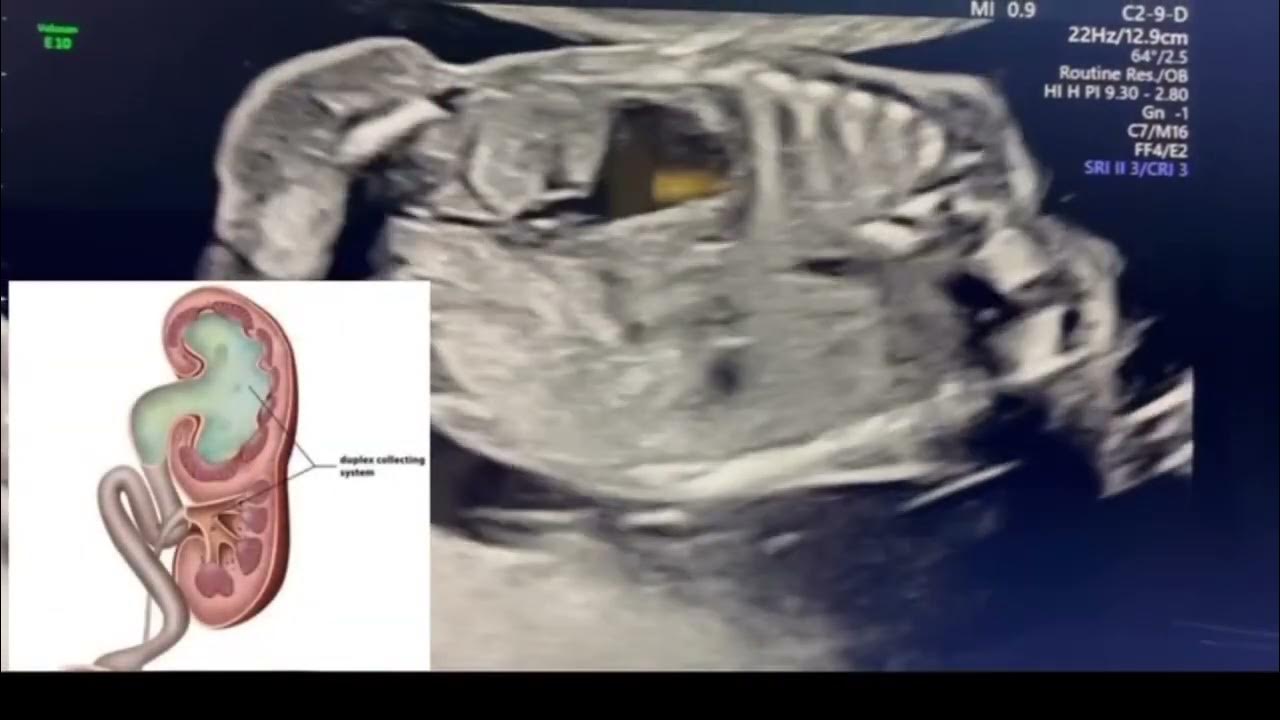 Duplex Kidney Fetal Ultrasound Duplicated Collecting System Fetal duplex-kidney-fetal-ultrasound-duplicated-collecting-system-fetal