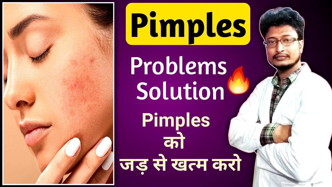 Pimples Removal On Face At Home Acne Removal Pimples Se Chutkara