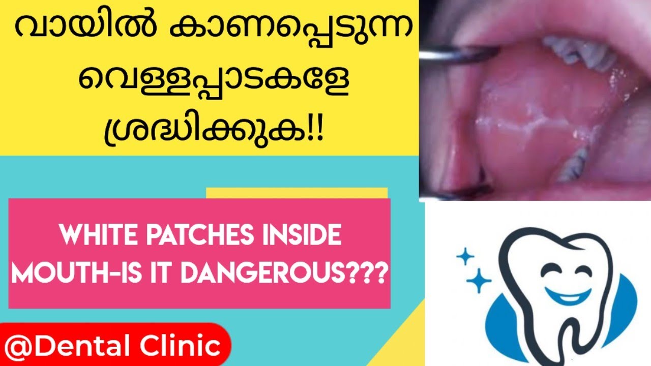 വായിൽ കാണപ്പെടുന്ന വെള്ള പാടകളെ ശ്രദ്ധിക്കുക| White patches in mouth|Dental Clinic
