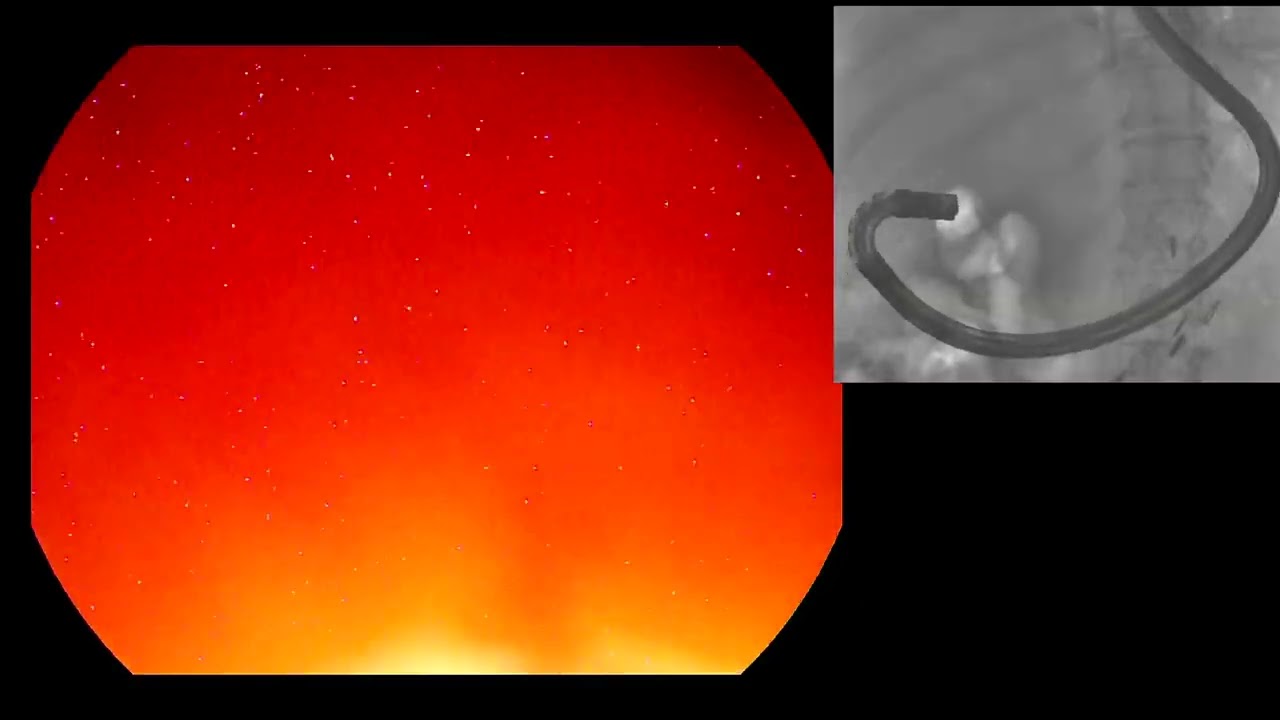 Florida Live Endoscopy Educational Video || Tips for single-step transgastric EUS and ERCP