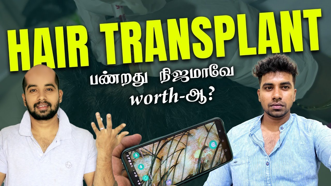 PART 1 | FIRST time Hair Transplant Try பண்ண போறேன் |கைகுடுக்குமா Technology | JUUJEE VLOGS