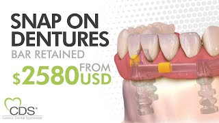 What Is A Bar Retained For Snap On Dentures In Mexico? Cancun Dental Specialists