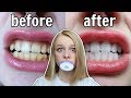 I tried WHITENING MY TEETH for the FIRST TIME! 👄 *at home*