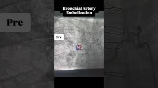 #dralokkudiya #intervention Bronchial Artery Embolization (BAE)