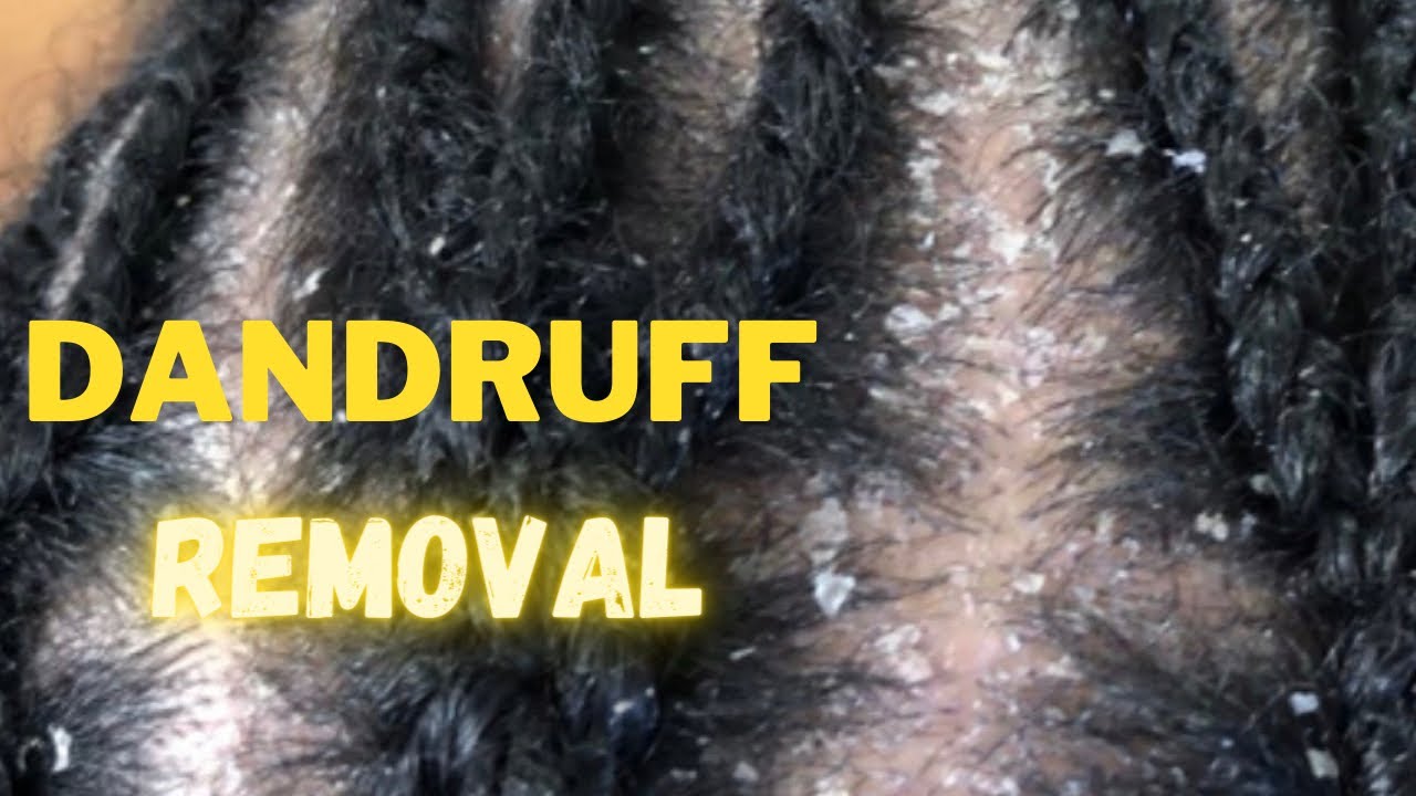 dandruff-scratching-removal-and-treatment-youtube