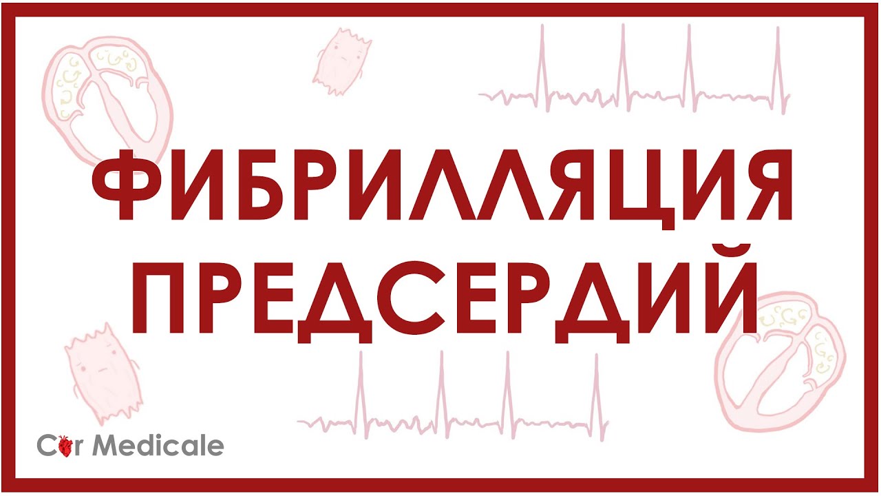 Фибрилляция предсердий