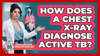 How Does a Chest X-Ray Diagnose Active TB?