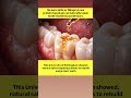 New gel restores dental enamel and could revolutionise tooth repair #biogel #bioceramic #toothgel