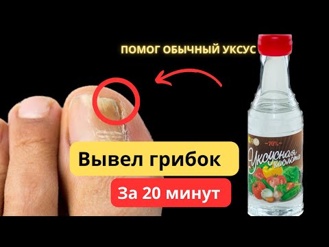 Спастись от ГРИБКА НОГТЕЙ за 20 минут? У ВАС есть это средство!