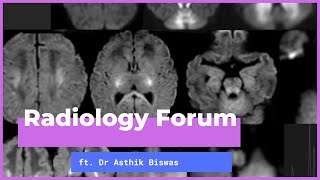 'Common Paediatric Neurometabolic Disorders  Early Imaging Recognition' by Dr Asthik Biswas