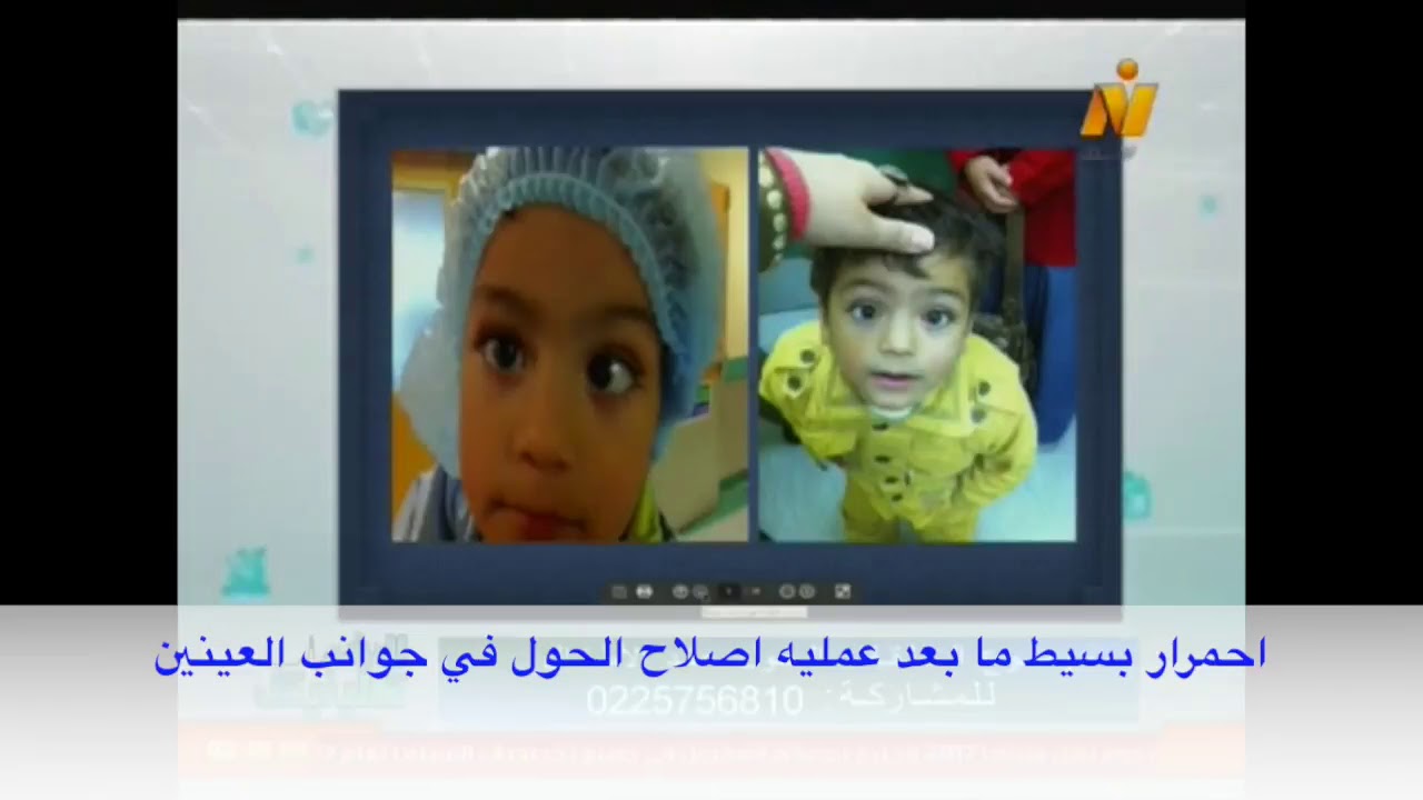 الحول الانسي للأطفال الرضع