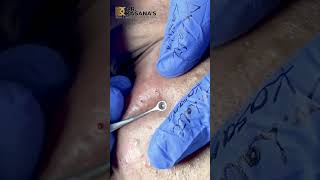 DEEP BLACKHEADS REMOVAL By Dr Lalit Kasana