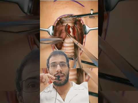 Video: Cómo realizar un tratamiento de traqueotomía (con imágenes)