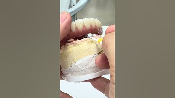 Awesome hygiene and Metal free full mouth zirconia implant!