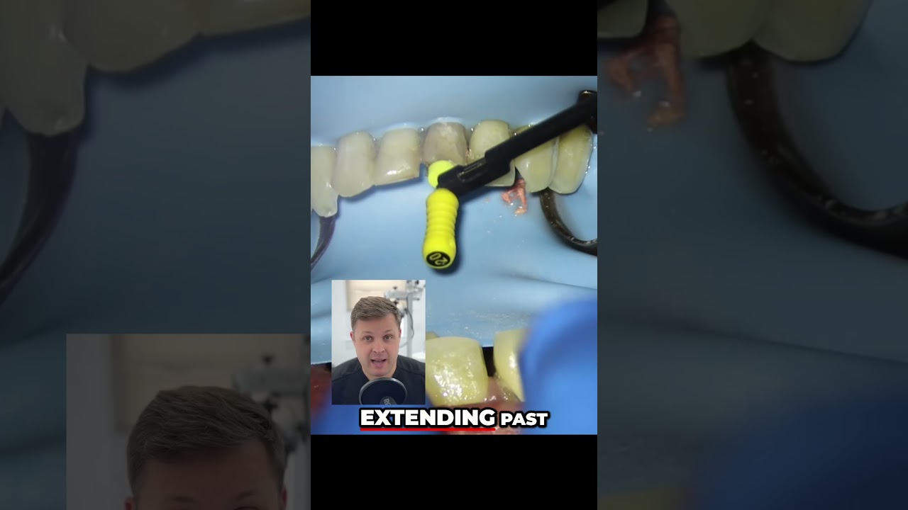 Root Canal Success  Apex Locator & Hedstrom File Demo