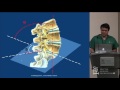 Full Endoscopic Lumbar Surgery: Indications, Techniques, & Avoiding Complications - James Yue, MD