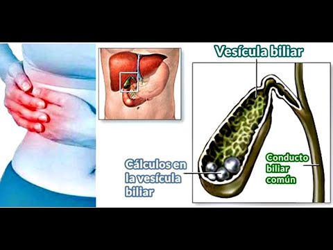 Calculos biliares dieta