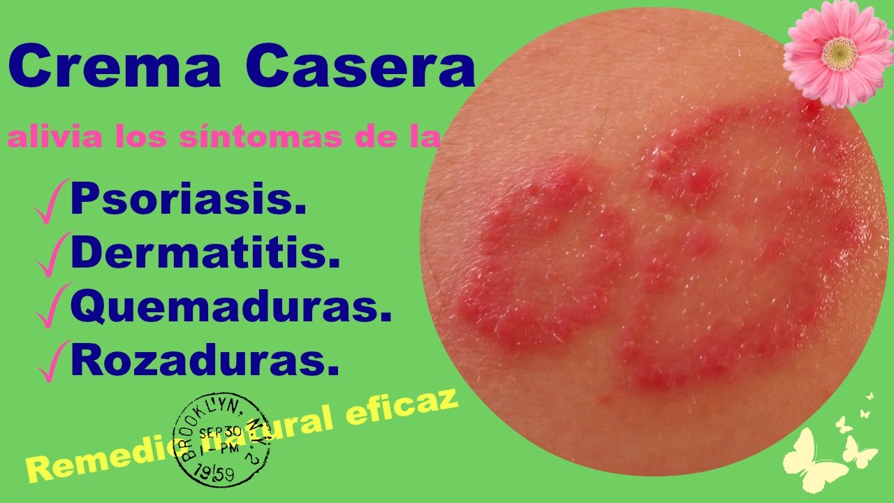 remedios naturales contra la dermatitis seborreica en la cara