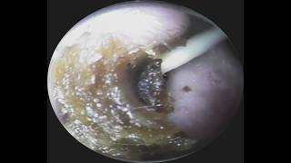 Vol.336【耳掃除】3年ぶりの耳掃除、左耳からサザエのような耳垢が!・・eariss luana