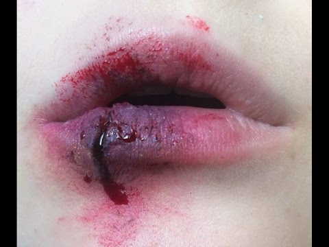 Busted lip pictures